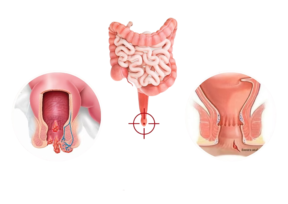 Fissura anal: da prevenção com dieta ao tratamento eficaz